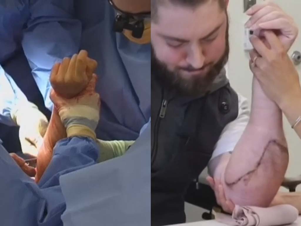 美國海軍陸戰隊員成功移植雙臂